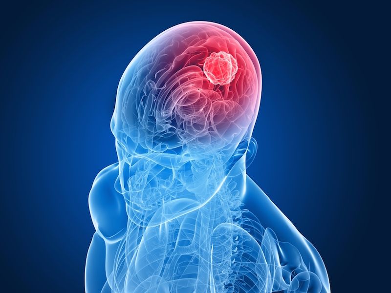 Brain Tumour Classification